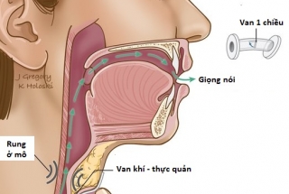 SỬ DỤNG BỘ PHẬN NHÂN TẠO CHO NGƯỜI BỆNH UNG THƯ